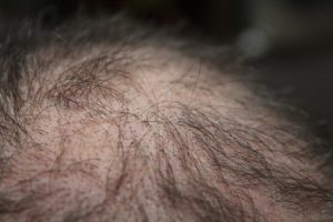 Low Carb Nebenwirkung Haarausfall